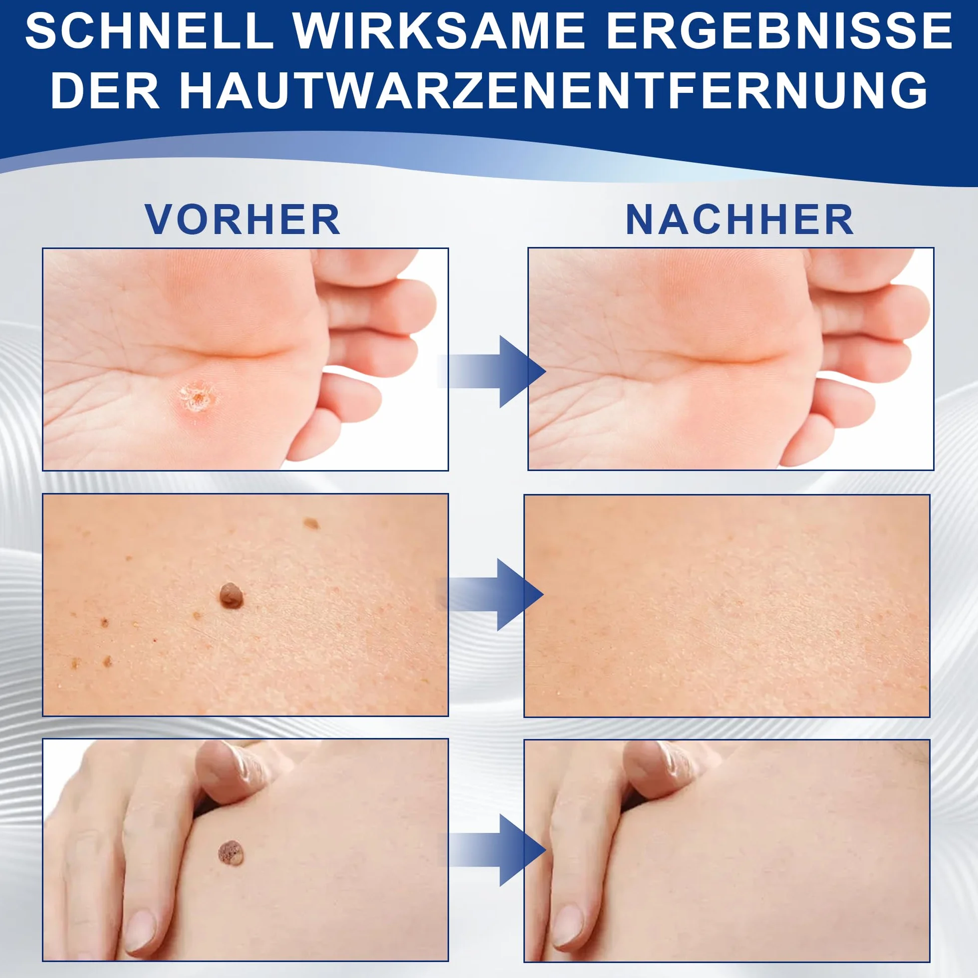 Sanfte Warzenentfernung für Gesicht & Körper - Schnell wirkendes Serum mit Präzisionstropfer, Sanfte Formel für sensible Haut, Reisegröße (10ml)
