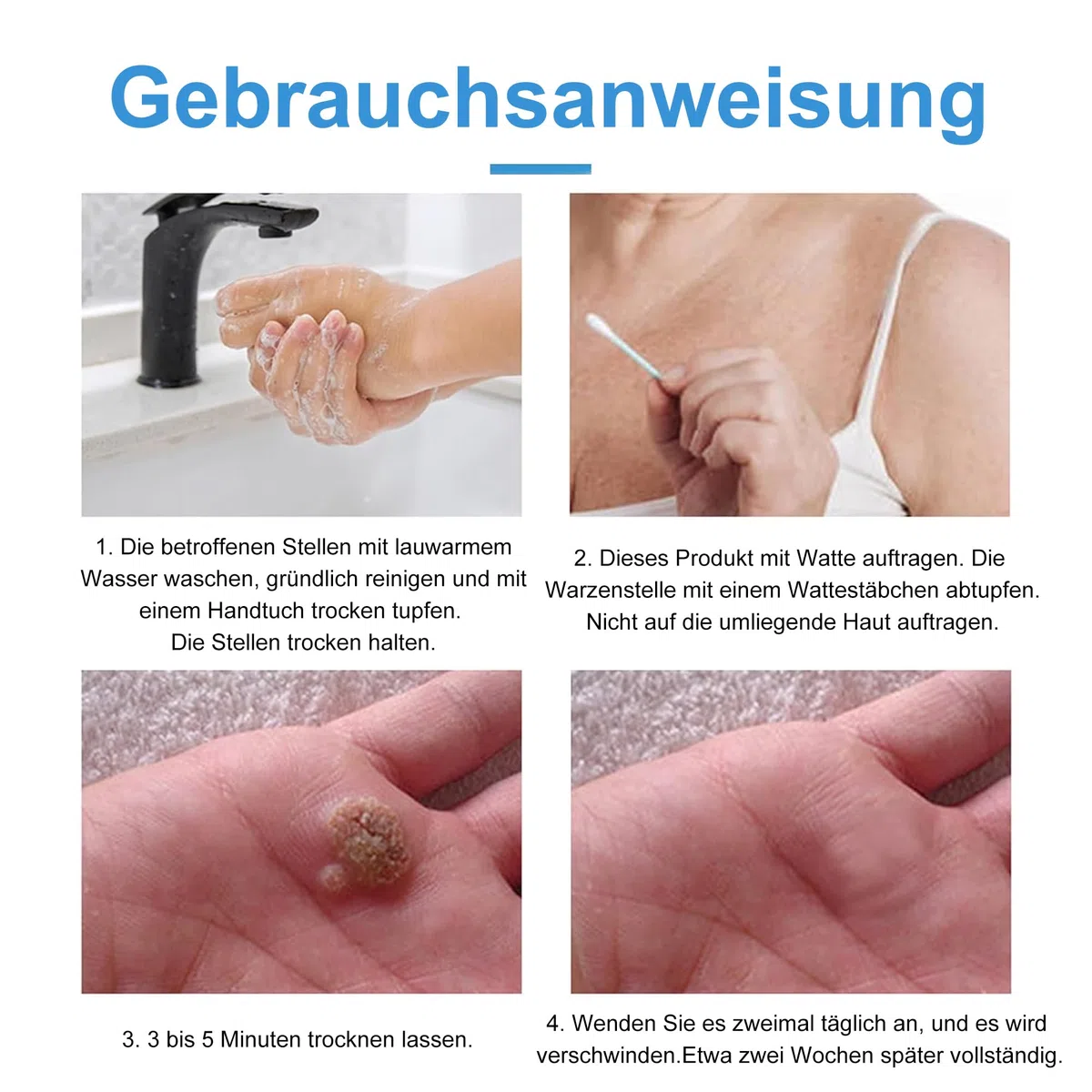 Warzenentfernungscreme für Gesicht und Körper - 20g
