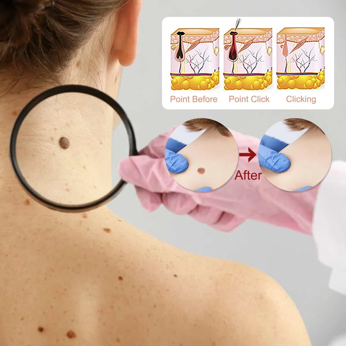 Sanfte Warzenentfernung für Gesicht & Körper - Schnell wirkendes Serum mit Präzisionstropfer, Sanfte Formel für sensible Haut, Reisegröße (10ml)